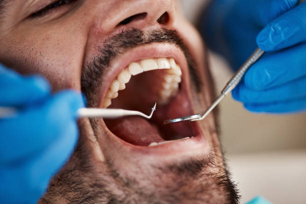 Best Emergency Wisdom Teeth Removal in Bethlehem Village, CT